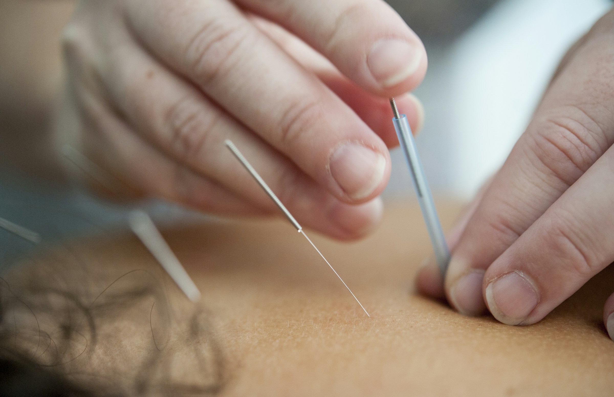An acupuncturist placing a fine needle, with needles already set in the skin
